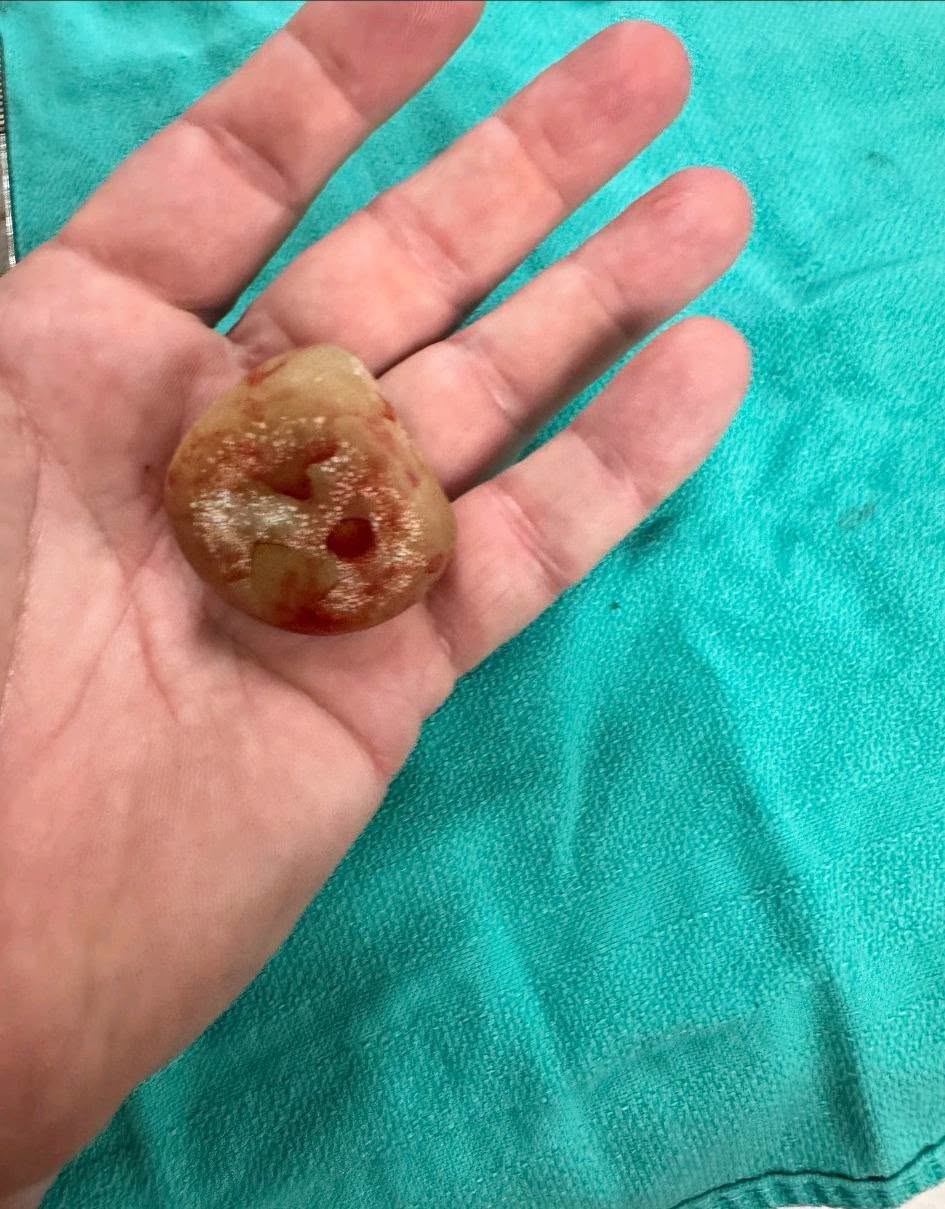 An open hand holding the single largest bladder stone removed from Sully