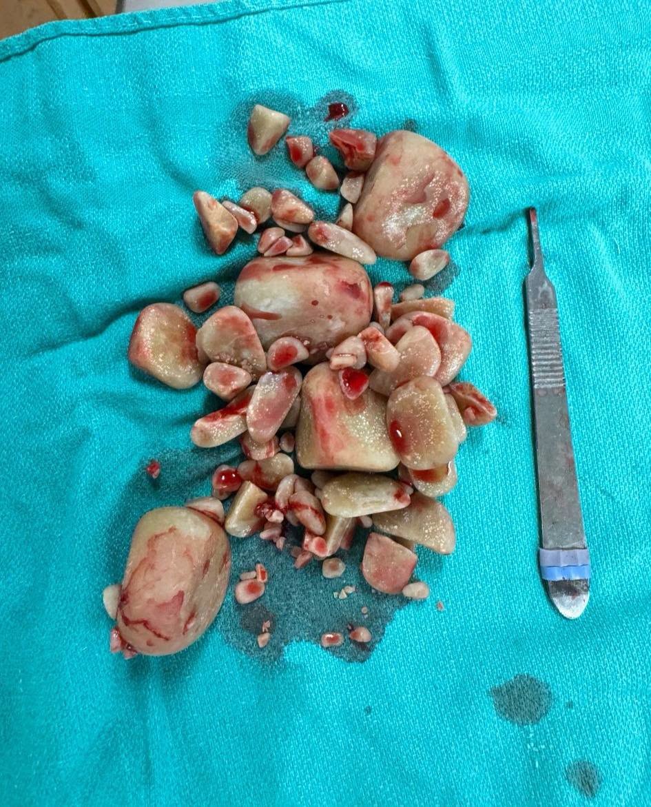Dozens of bladder stones removed from Sully, laid out on a surgical drape beside a scalpel